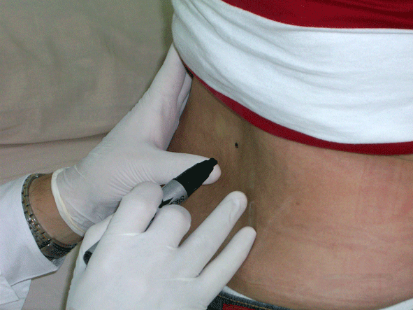 Marcaje Hernia Discal